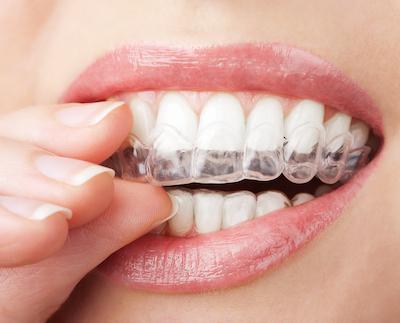 Woman using Invisalign clear braces in Randolph, NJ