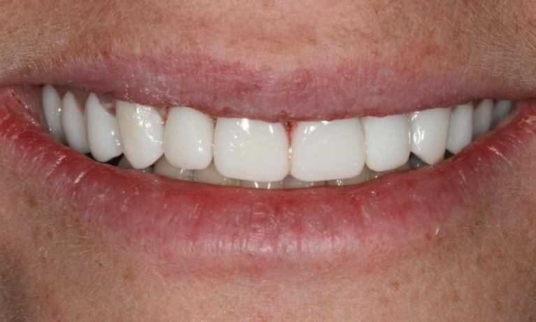 smile after dental crowns and veneers