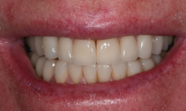 close up of teeth after whitening and other restorations