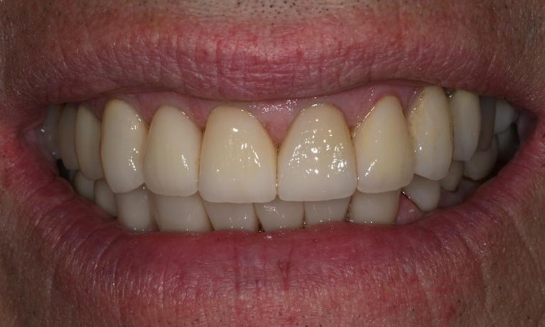 close up of smile after cosmetic restoration