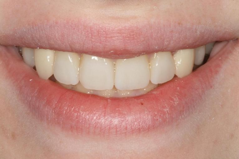 patient's smile after cosmetic dental services