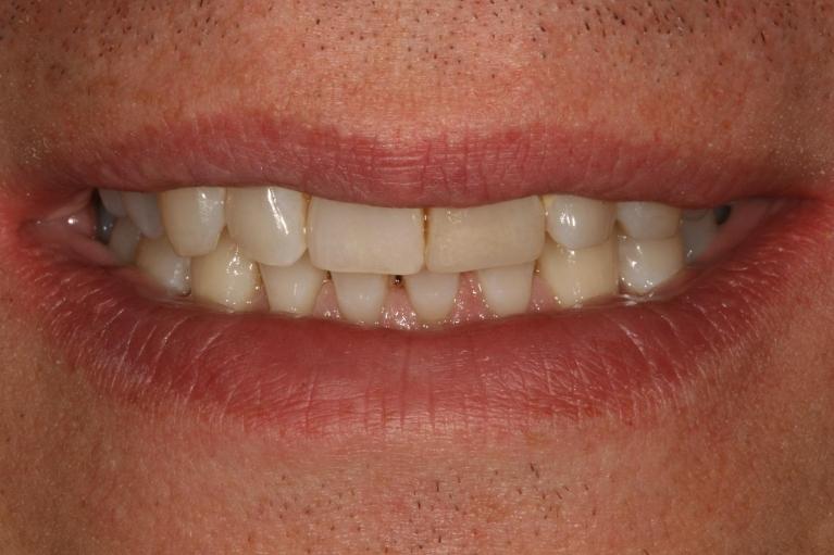 patient's smile after invisalign treatment