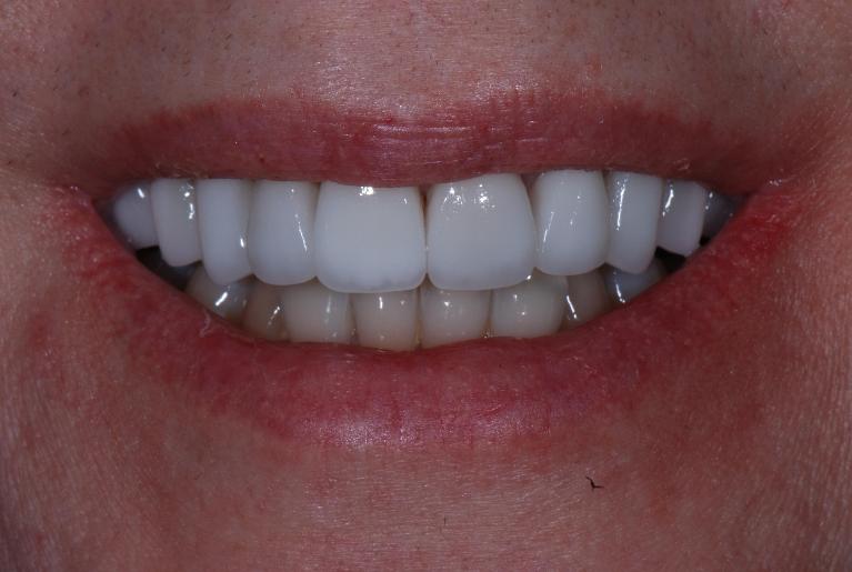 porcelain veneers used to brighten patient's discolored teeth