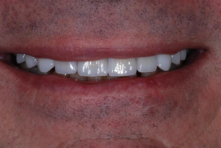 veneers used to transform this patient's yellowed teeth