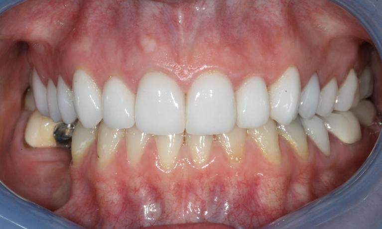 smile after dental crowns and veneers
