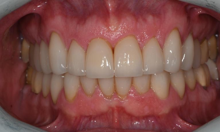 close up of teeth after whitening and other restorations