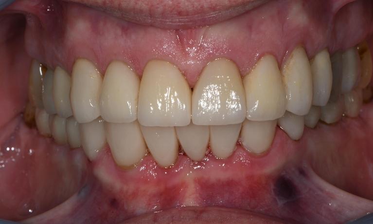 close up of smile after cosmetic restoration