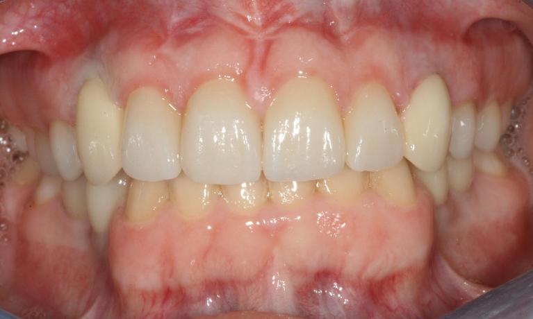 patient's smile after cosmetic dental services
