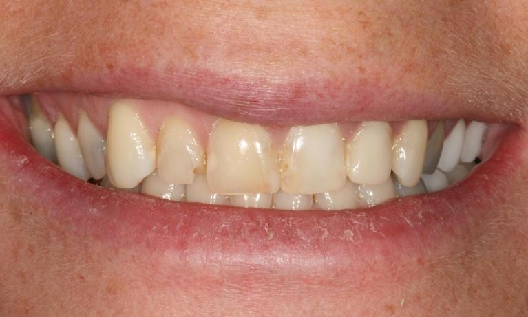 older smile before crowns and veneers