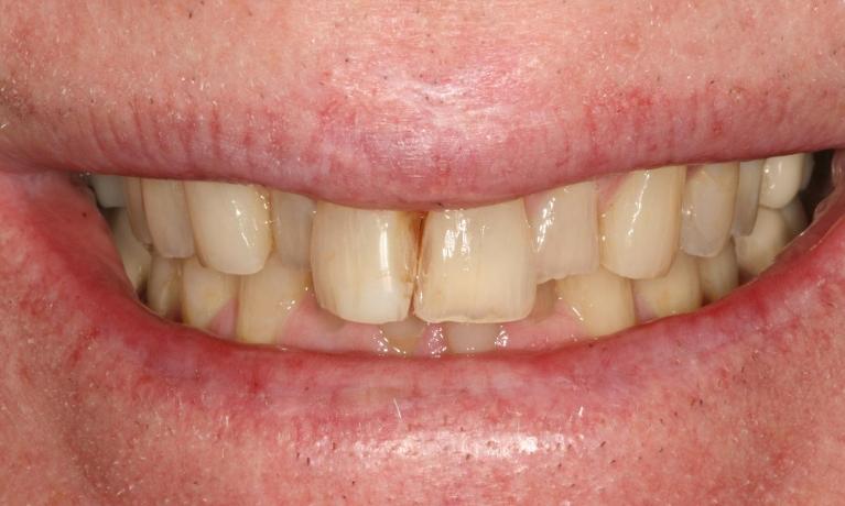 close up of smile before cosmetic restoration