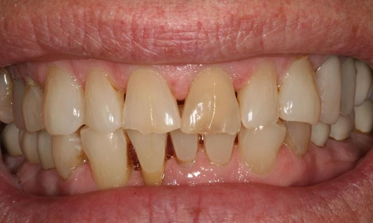 gaps in smiles and discolored teeth