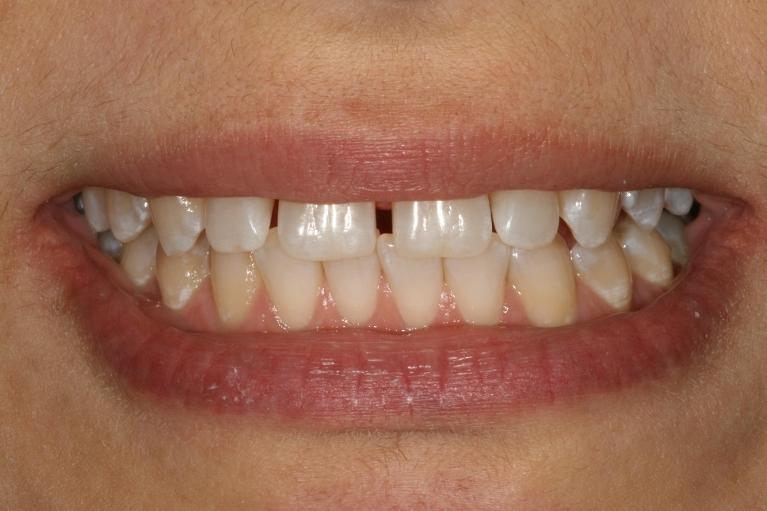 spaces in front teeth