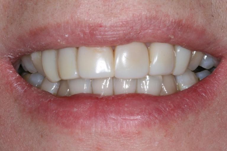 discolored teeth before veneers