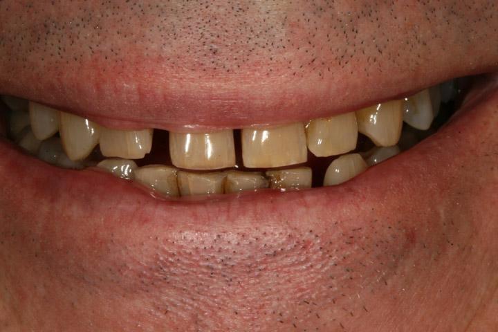 yellowed and worn teeth