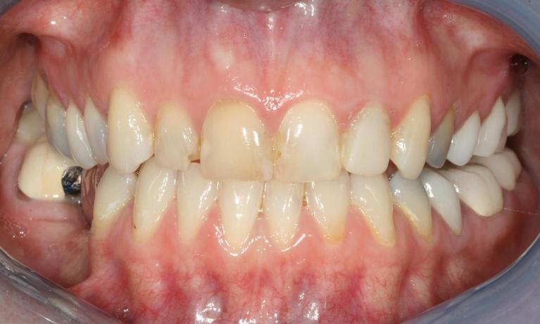 older smile before crowns and veneers