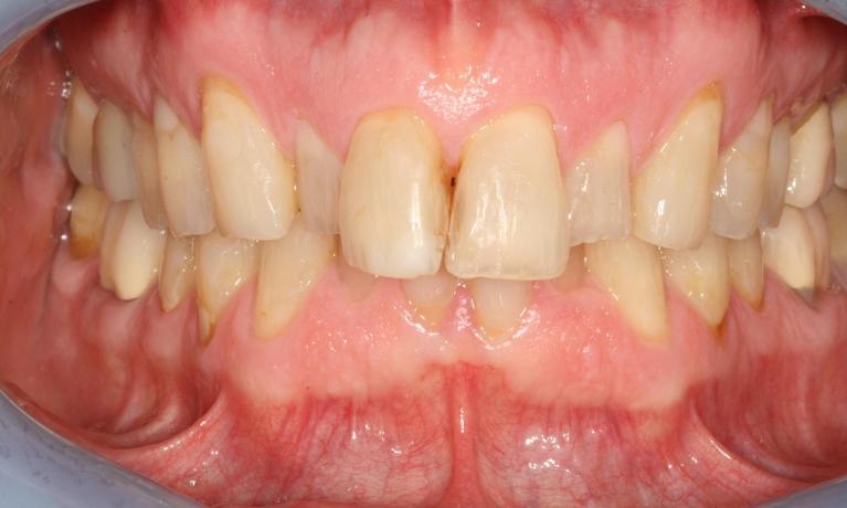 close up of smile before cosmetic restoration