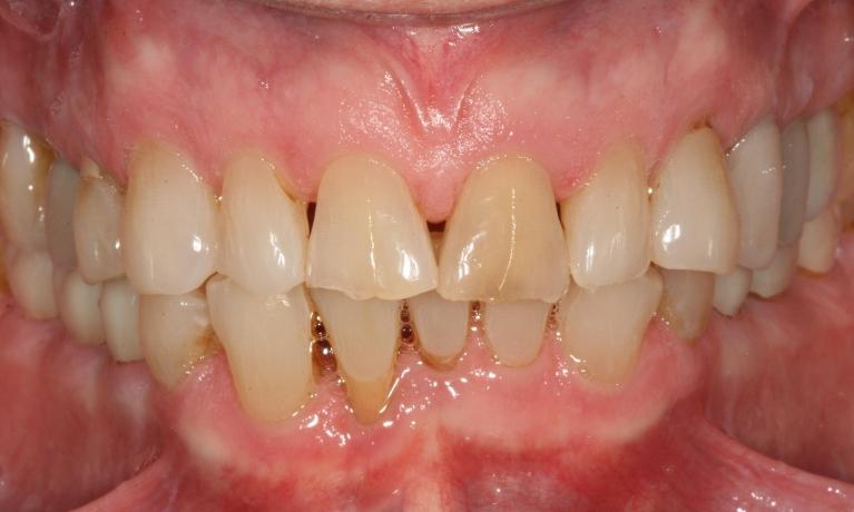 gaps in smiles and discolored teeth
