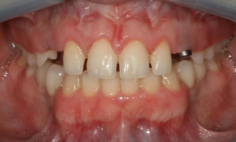 picture of mouth with small and gapped teeth