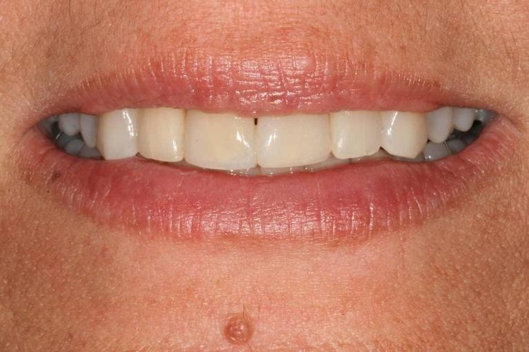 invisalign straightened this patient's misaligned front teeth